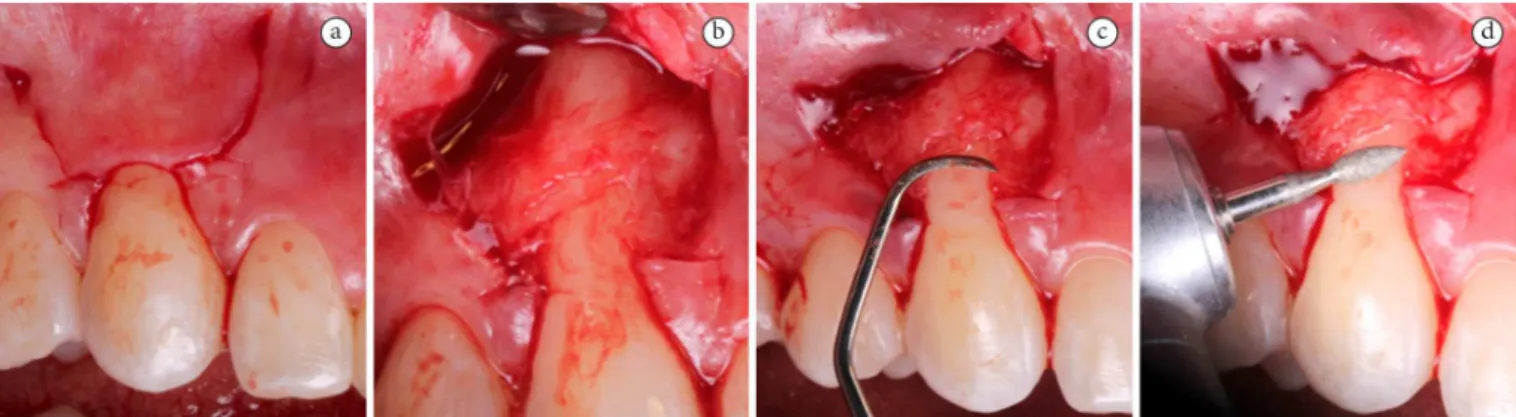 Figure 1. Sequence of surgical procedure: (a) lap design; (b) protrusion of the lap; (c) smoothing the roots with manual instruments and  (d) with rotary instruments.