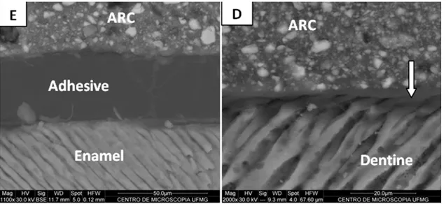 Figure 1. RelyX ARC interface ater total-etch (phosphoric acid 37%) and Scotchbond Multipurpose Plus: (E) enamel, (D) dentin
