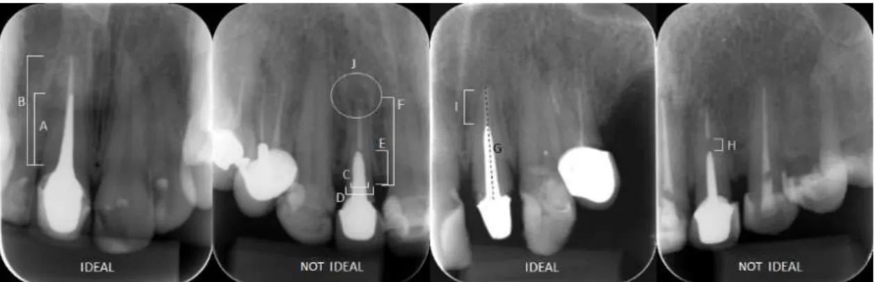 Figure 1. Measures obtained for each assessed tooth. A = 2/3 × B (ideal post length); C = 1/3 × D (ideal post diameter); E = 1/2 × F (ideal  post:bone crest ratio); G = post contiguous to root canal; H = presence of gap between the remaining root canal ill