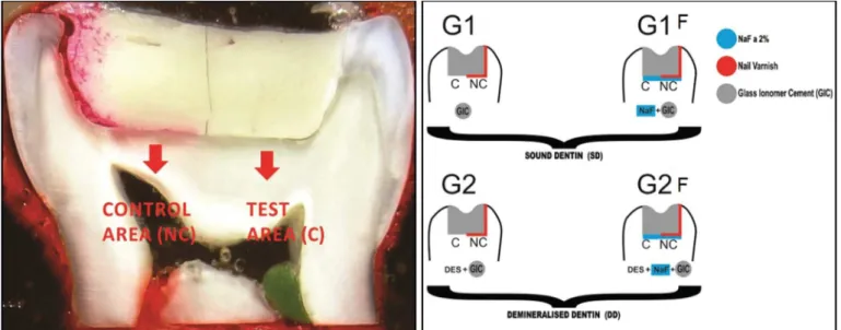 Figure 1. Sagittal section of teeth restored with GIC in two dentin conditions: sound/ demineralized (G1, G2) and with topical application of luoride  (NaF) before restoration (G1F, G2F)