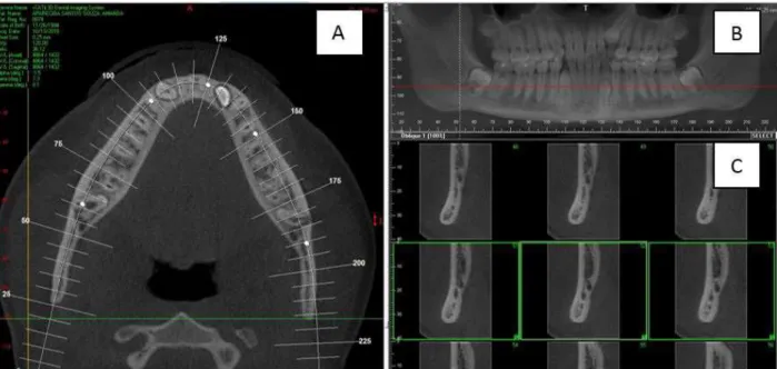 Figure 2. Image demonstrating a retromolar canal in close relationship  with a horizontally impacted third molar.