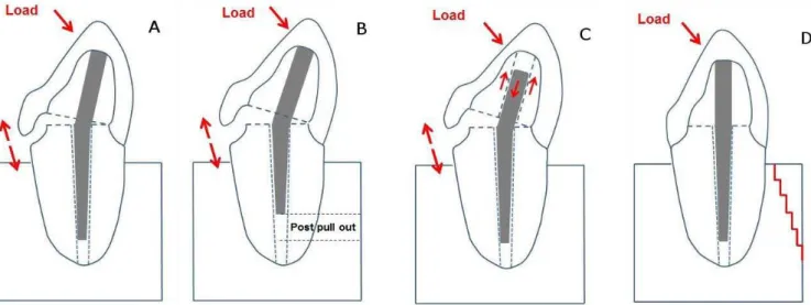 Table 1. Fracture load (N) means and standard deviations (SD), failure modes ater the fracture load test and displacement