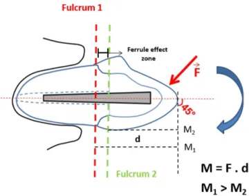Figure 2 shows a representation of the bending moments on the  post. Fulcrum 1 is formed on the cervical level by 45° load and  cervical surface of the root