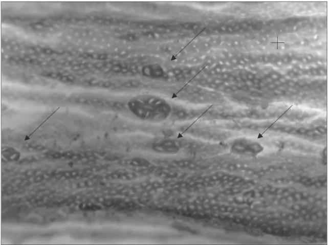 Figure 2. Normal colonic mucosal area (+) and presence of five Aberrant Crypts Foci (ACF)