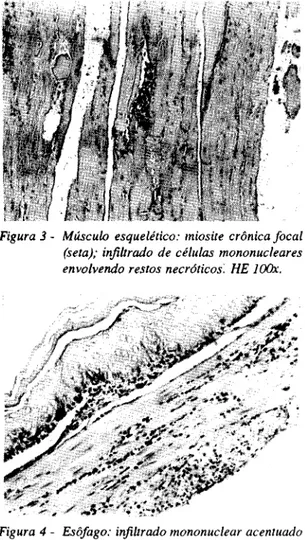 Figura  3 -  M úsculo  esquelético:  miosite  crônica fo c a l (seta);  infiltrado  de  células  m ononucleares envolvendo  restos  necróticos