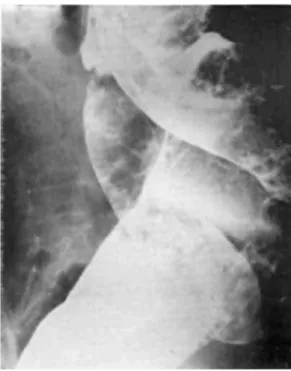 Figure 1A - Cha ga sic mega esopha gus showing stenosis