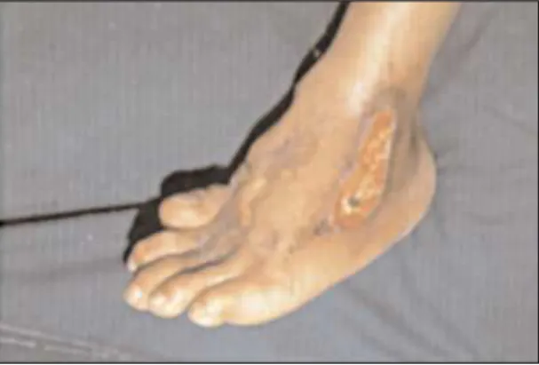 Figura 1 - Ulcera crónica por Fusarium oxysporum post traumática, de 2 meses de evolución.
