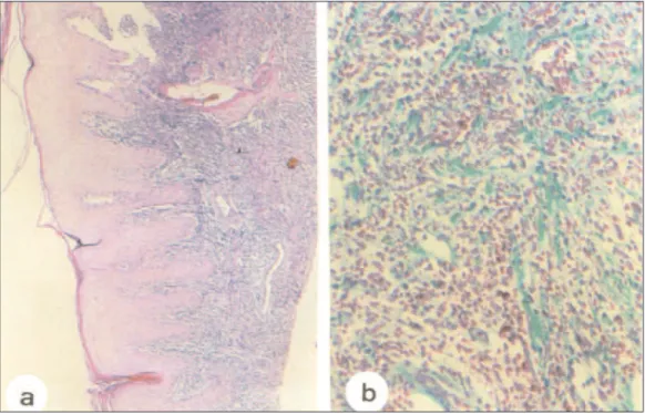 Figure 1 - a,b: skin of the ankle of patient ABC, taken before treatment. Intense diffuse exsudation