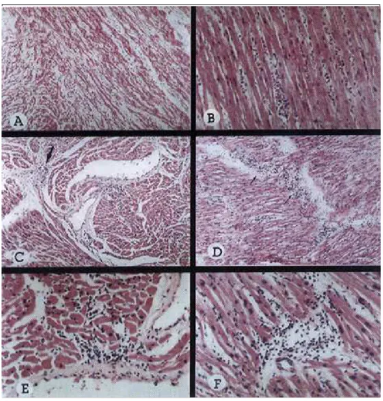 Figure 1 - Microscopic patterns of myocarditis in children who died of meningococcal disease: A) Severe interstitial edema and presence of some leukocytes apparently extravasated from vessels