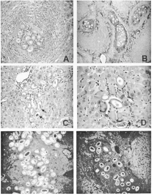 Figure 3A: Eggs of Capillaria hepatica appear surrounded with a halo of hyaline material and in the center of an acute inflammatory reaction containing a central zone of necrosis, infiltrated with disintegrated polymorphonuclear leukocytes (purulent necros