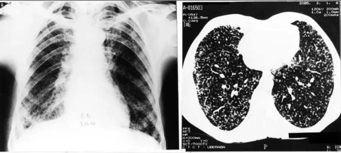 Figure 1 – Case 1 chest x-ray and CT, showing diffuse and bilateral micronodular interstitial and linear septal infiltrate.