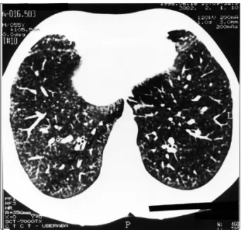 Figure 4 - Case 2 chest x-ray revealing diffuse and bilateral