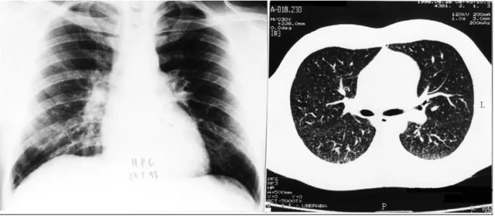 Figure 6 – Case 2 control chest x-ray and CT showing only a very discrete micronodular infiltrate.