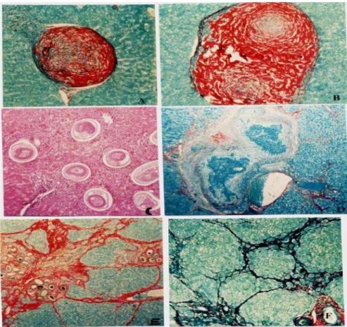 Figure 1 (A and B) - Focal fibrosis caused by the injection of immature C. hepatica eggs into the liver