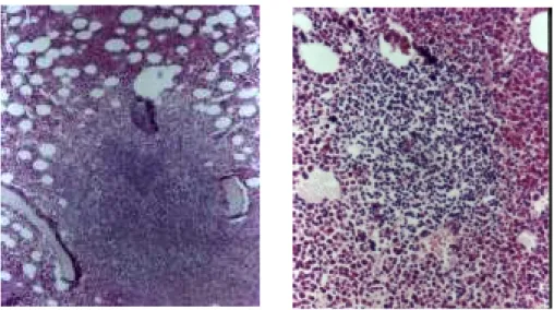 Figure 1 - Bone marrow biopsy section showing a poorly demarcated, large lymphoid aggregate in the immediate paratrabecular area (left) and a well circumscribed proliferation composed of small mature lymphocytes (right).