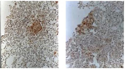 Figure  2 - Immunohistochemistry of bone marrow section, immunoperoxidase technique with hemotaxilin counterstain (left) Strong and central marking of lymphoid aggregate with monoclonal pan-B antibody (CD20) (right) Positive dispersed staining of lymphoid 