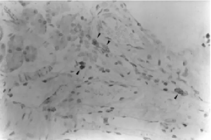 Figure 3 - PAP anti-T. cruzi test positive (arrows) in the pancreas sample where oncocytes were observed (x400).