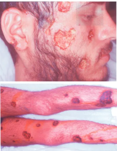 Figure 2 - Skin section. Several round to elongated yeast Sporothrix schenkii yeast cells