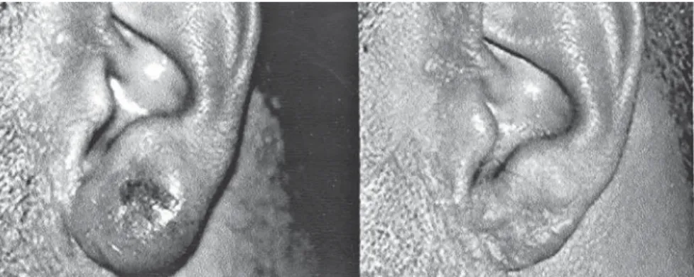 Figure 1 - Aspect of the lesion before (left) and after (right) long-term therapy.