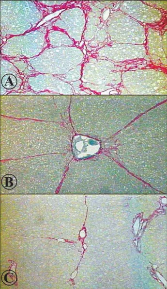 Figure 1 - Septal fibrosis of the liver: different degrees of fibrosis observed  in rats infected with Capillaria hepatica