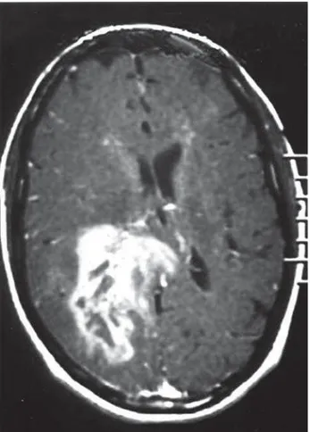 Figure 1 - Axial T1-weighted MRI showing a heterogenous right parieto- parieto-occipital lesion with irregular gadolinium enhancement and perilesional edema, before treatment.