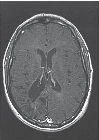 Figure 2 - Axial T1-weighted of the last MRI scan obtained three years after the diagnosis reveals a sequelar lesion with partial cavitation, the degree of enhancement and brain retraction.
