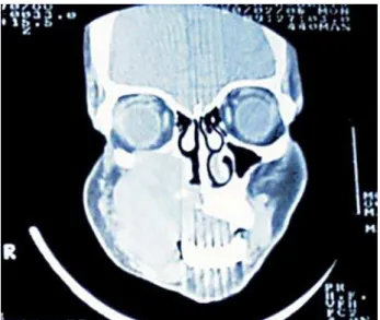 Figure 3 - Complete remission of the neoplasm after six cycles of  chemotherapy plus HAART.