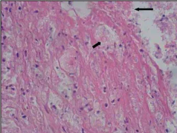 Figure 1 - Axial computed tomography image shows bilateral adrenal  mass.