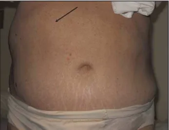 Figure 2 - Abdominal wall protrusion following herpes zoster at the  right flank.