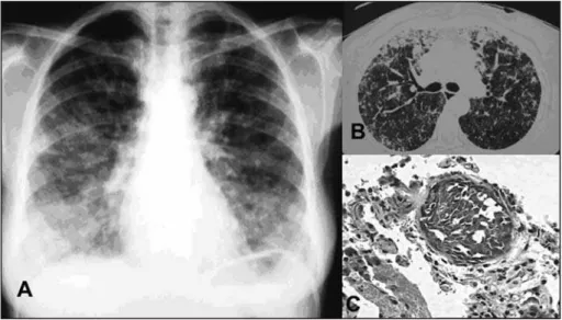 Figure 1 - Patient with pulmonary tuberculosis and associated carcinomatous lymphangitis