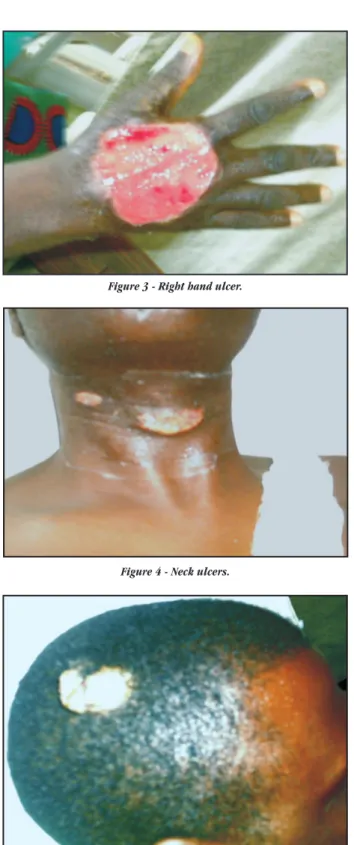 Figure 5 - Scalp ulcers, also on the right side.