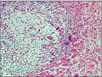 Figure  5  -  Micrograph  showing  tumor  cells  at  adrenal  cortex  and  Schistosoma.