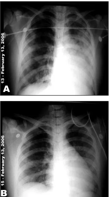 Figure 1 - X-ray images of case 3. A) Reticulonodular interstitial  infiltration seen initially, with tendency towards lower left  consolidation
