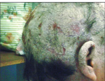 Figure 1 - Infectious dermatitis in scalp and external auricle.