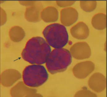 Figure 2 - Flower cell in peripheral blood.