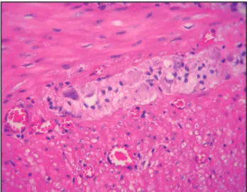 Figure 1 - Macroscopic photograph of histological section through the  middle portion of the sigmoid, in which the intestinal ring was twisted  on itself