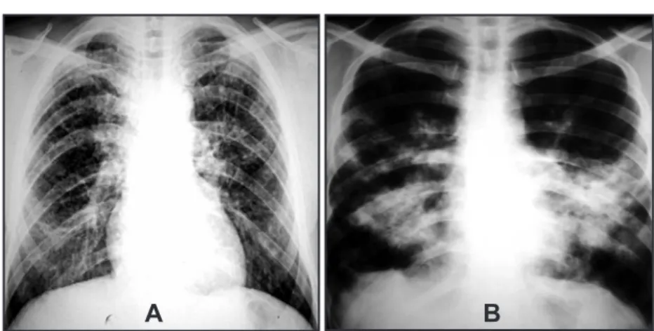FIGURE 1 - A) Postero-anterior chest x-ray. Case #2, male, 49 year-old: reticular-nodular patern
