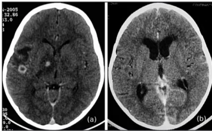 FIGURE 1 - A: Initial contrasted CT scan of the brain showing hypodense nodular lesions  with ring enhancement in the right basal ganglia and subcortical region with marked  perilesional edema afecting the ipsilateral internal capsule
