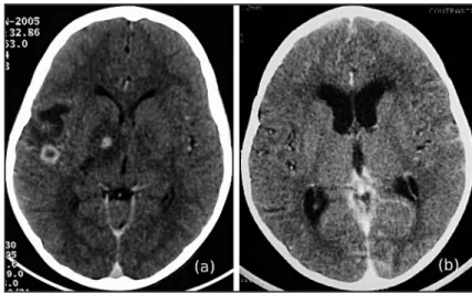 FIGURE 1 - A: Initial contrasted CT scan of the brain showing hypodense nodular lesions  with ring enhancement in the right basal ganglia and subcortical region with marked  perilesional edema afecting the ipsilateral internal capsule