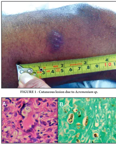 FigURE 1 - Cutaneous lesion due to Acremonium sp.