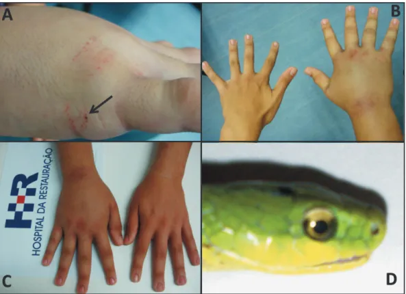 FigURE 1 - A) Lesion ater the snakebite in the present case. he arrow indicates the site of inoculation by the opistoglyph  dentition, on the right hand