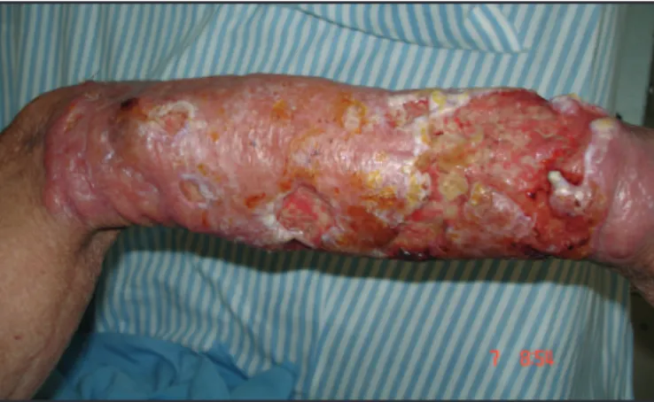 FIgURE 1 - Skin lesion associated with Cryptococcus gatii infection on the let  forearm of a patient who had been on chronic corticotherapy.