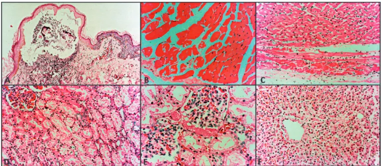 FIGURE 1 -  a  Skin showing subepidermal vesicle with epidermal necrosis and mononuclear inlammatory iniltrate at the base associated with vasculitis