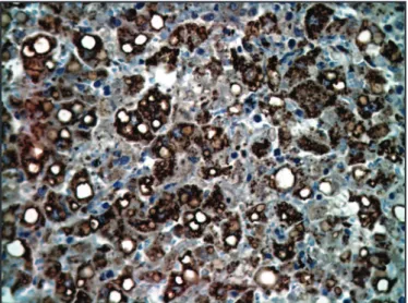 FIGURE 2 - Hepatocytes positively imunostained with  anti-anti-antigen of  yellow  fever  virus  amplified  in  reaction  with  enzyme-conjugated  polymer  (X400).