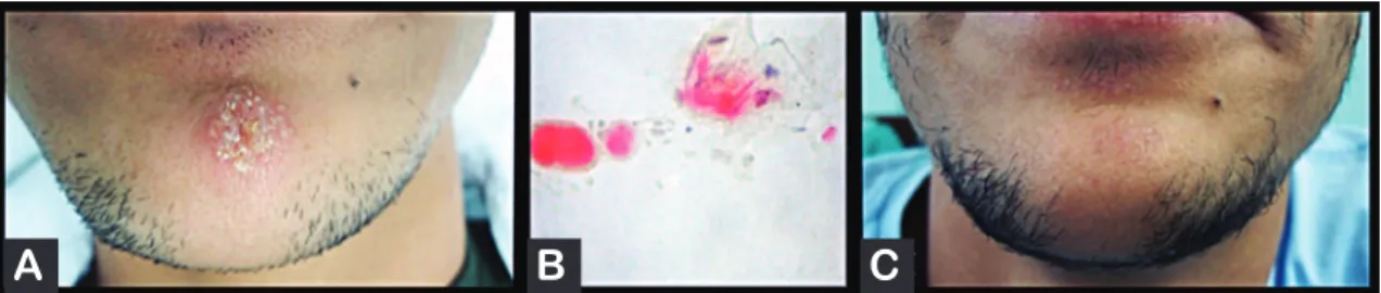 FIGURE 1 – A: Patient 1 presenting an ulcerative lesion in perioral region. B: Cytopathology of the lesion of the patient 1 – demonstrating  binucleation and nuclear molding 