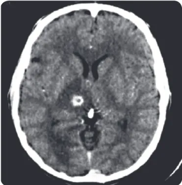 FIGURE 1 - Computed tomographic scan showing the typical ring-like appearance of  a lesion located in the right thalamus (case 2)
