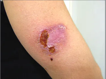 FIGURE 1 - Clinical aspect when the irst biopsy was performed, 2006 August. 