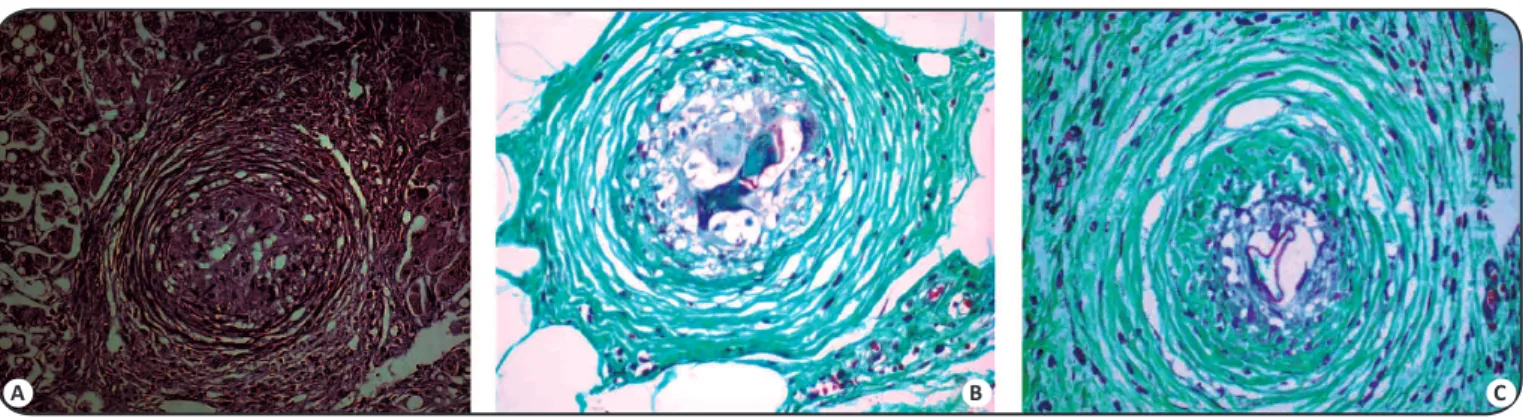 FIGURE 2 - Granuloma in ibroic healing phase, with external zone (Z3) delineated by parallel and circular connecive ibers, stained by HE in liver (A), and stained by trichromic  in large intesine (B) and from peritoneum (C) as a result of modulaion, in the
