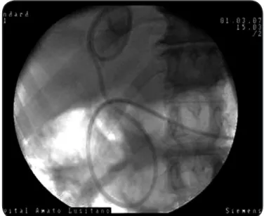FIGURE 2 - Endoscopic retrograde cholangiopancreatography showing  contrast cyst formaion with easy cannula access.