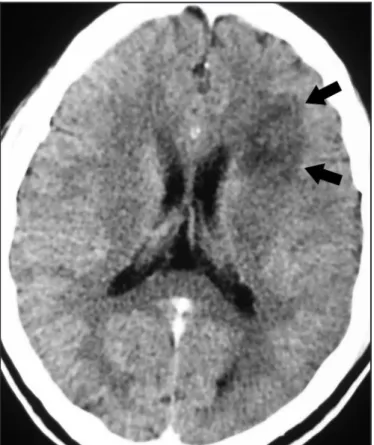FiGURE 1 - Axial computed tomography of the brain ater contrast administration. 
